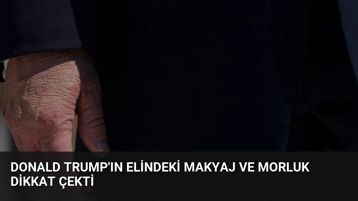 Donald Trump’ın Elindeki Makyaj ve Morluk Dikkat Çekti